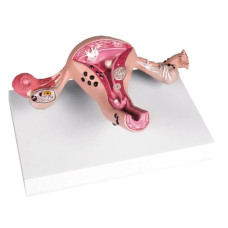 Modelul uterului cu boală Erler-Zimmer