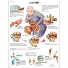 Diagrama bolii Alzheimer