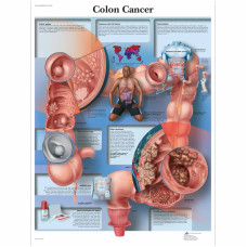 Diagrama cancerului de colon