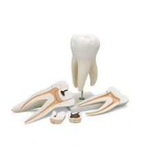 Model molar gigant cu cavități dentare (5 părți)